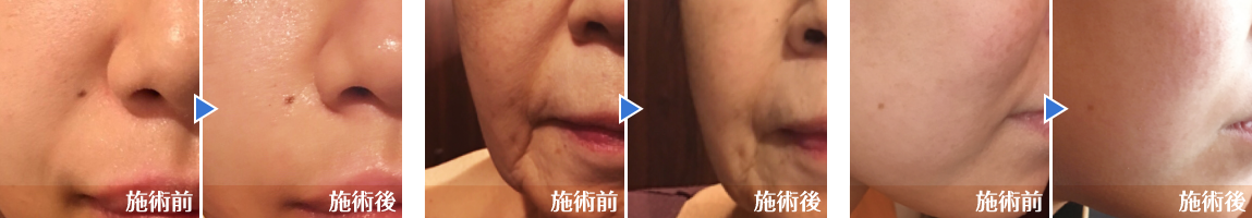 毛穴、ほうれい線が目立たなくなり若々しい印象